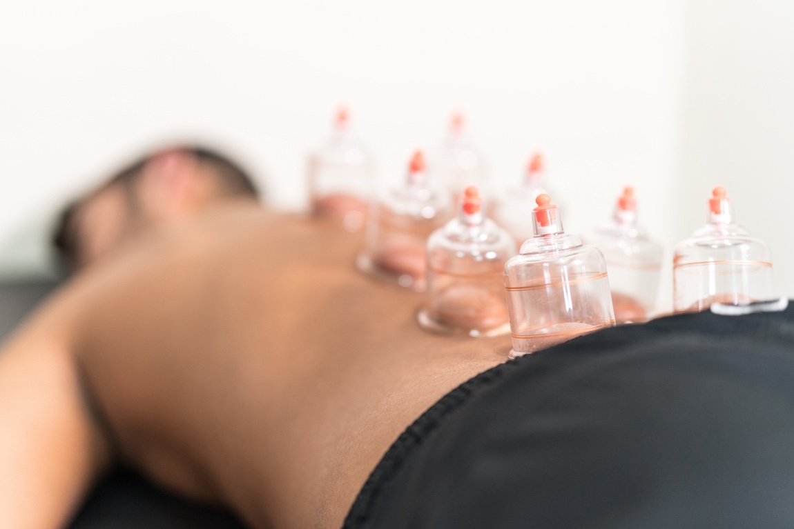chiropractic cupping therapy in tampa, Florida